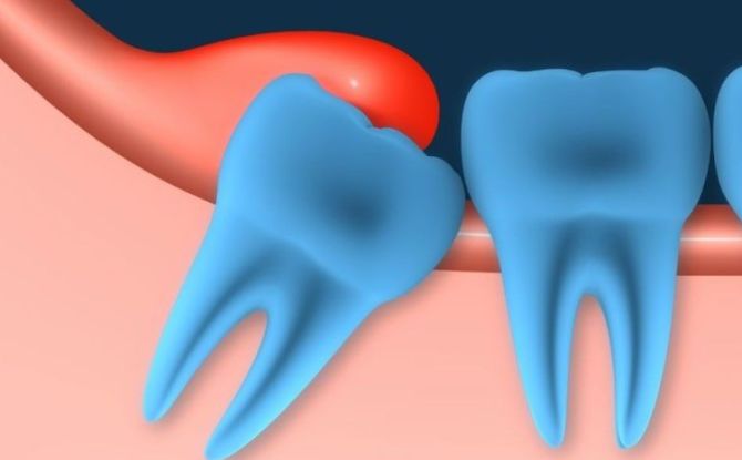 اللثة ملتهبة وتورم بالقرب من الأسنان الحكمة: الأسباب والأعراض والعلاج في العيادة والمنزل