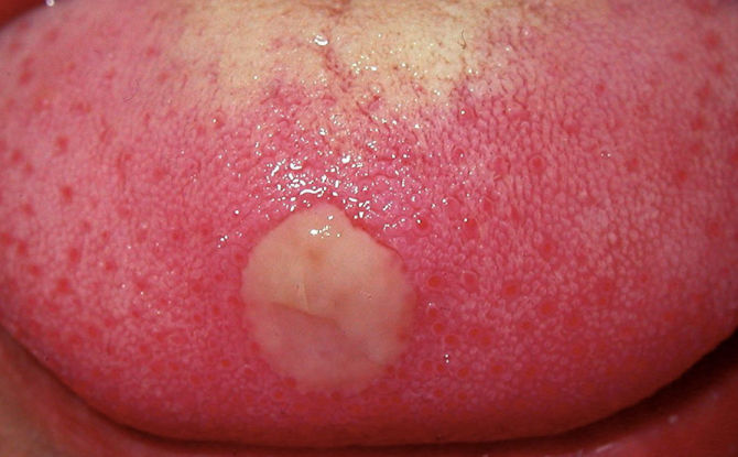 التهاب الفم في اللسان عند البالغين: الأسباب والأعراض والأنواع وكيفية وعلاج ما