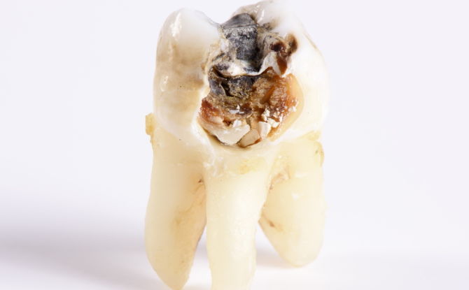 الأسنان الفاسدة: الأسباب والعواقب المترتبة على الجسم ، وماذا تفعل مع الأسنان الفاسدة