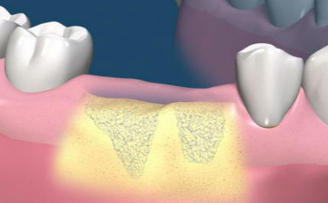 تمديد أنسجة العظام قبل زرع الأسنان: جوهر الإجراء ، الطرق ، المراحل ، التكلفة