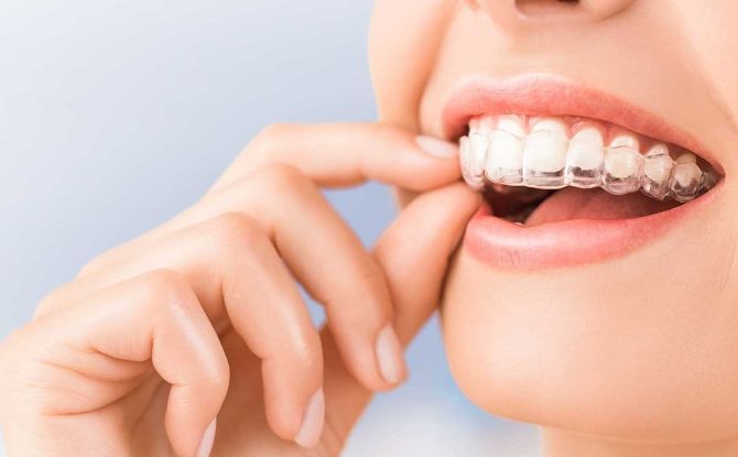 كيفية محاذاة الأسنان الأمامية ومضغها دون وجود دعامات عند الأطفال والبالغين