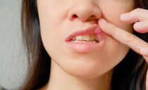 علاج التهاب الفم في الفم لدى البالغين في المنزل