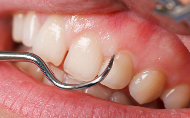 لماذا تؤلم الأسنان تحت التاج وماذا تفعل حيال ذلك