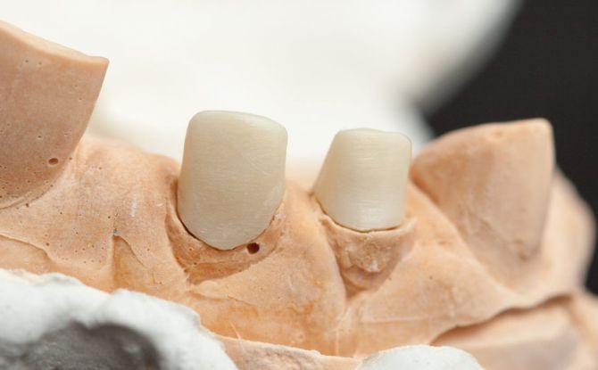 جدعة تبويب للأسنان تحت التاج: ما هو ، أنواع ، التكلفة