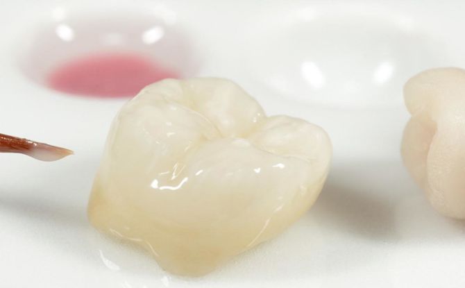 التيجان على الأسنان: أنواع ، إيجابيات ، سلبيات وإجراءات التثبيت