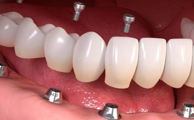 تصنيف زرع الأسنان من قبل الشركات المصنعة