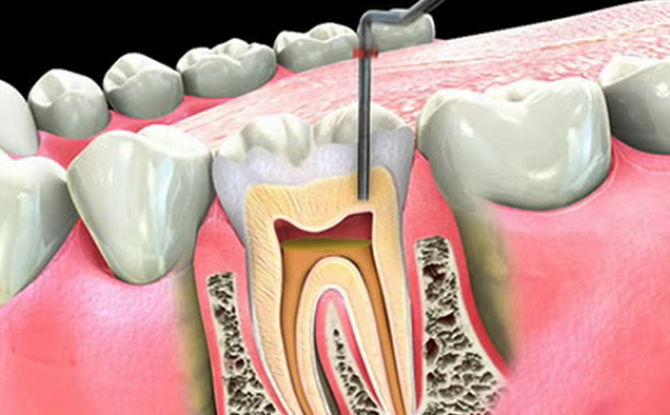تؤلم الأسنان بعد إزالة الأعصاب وملء القناة: لماذا وماذا تفعل؟
