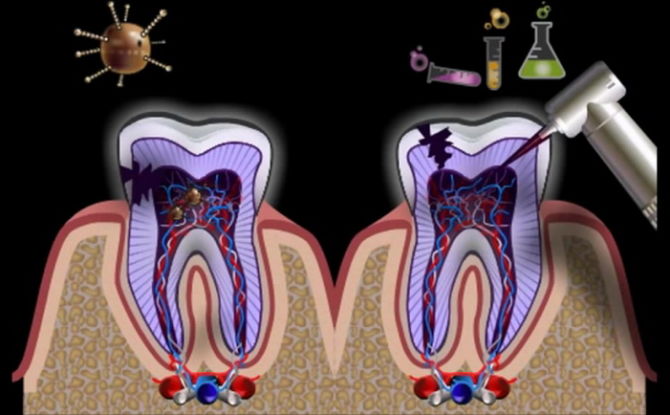 التهاب جذر السن وقنوات الأسنان: العلامات والأعراض والعلاج