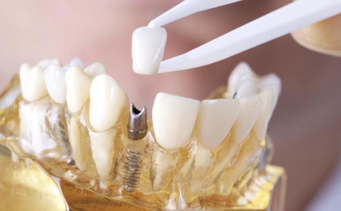 كيفية وضع تاج على الأسنان: مراحل وعملية التثبيت ، إعداد الأسنان ، هل من المؤلم وضعه
