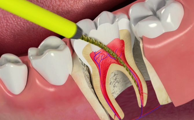 التهاب لب الأسنان: كيفية علاج وطرق ومراحل العلاج والمضاعفات والوقاية