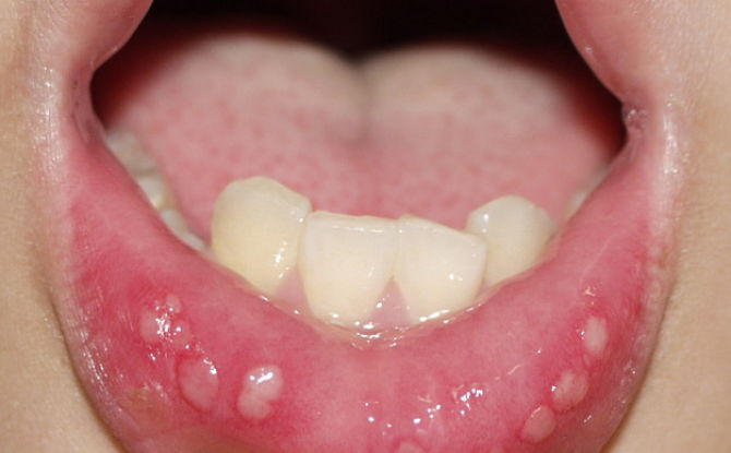 أسباب ظهور وعلاج تقرحات الفم لدى الطفل