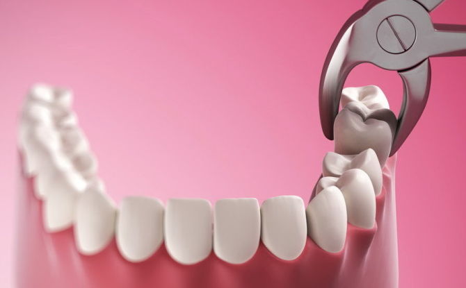 هل من الممكن إزالة الأسنان أثناء الحمل ، كيف تتم عملية الإزالة