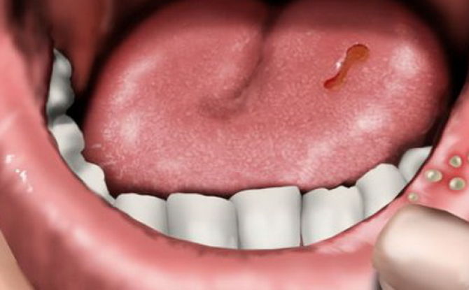 التهاب الفم في الفم لدى البالغين: سواء حدث ذلك ، وكيف ومع ما يجب علاجه