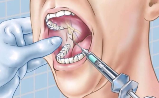 إجراء التخدير في طب الأسنان - ما هو عليه ، والأنواع
