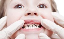 تسنين الأسنان عند الأطفال: لماذا من الضروري ، مؤشرات ، طرق تسنين الأسنان الأولية