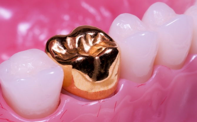 أنواع التيجان على الأسنان ، والتي يتم وضعها بشكل أفضل على التيجان ومضغ الأسنان