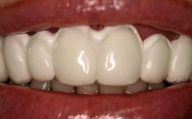 إعادة تمعدن مينا الأسنان في طب الأسنان وفي المنزل