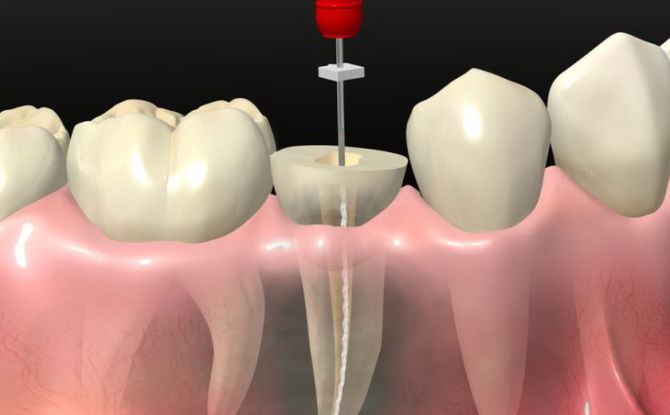ما هو إزالة الأسنان ، طرق إفراز مع الأطراف الصناعية