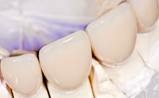 التيجان على الأسنان الأمامية: أنواع كيفية صنعها وتحديد كم تكلفتها