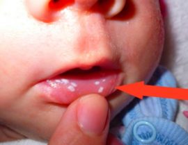 بقع بيضاء في فم الطفل مع داء المبيضات