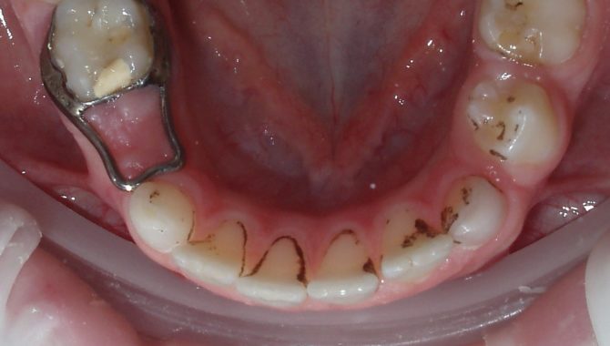 Dents noires chez les enfants