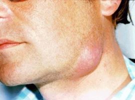 التهاب شديد في العقدة الليمفاوية تحت الفك السفلي في الرقبة